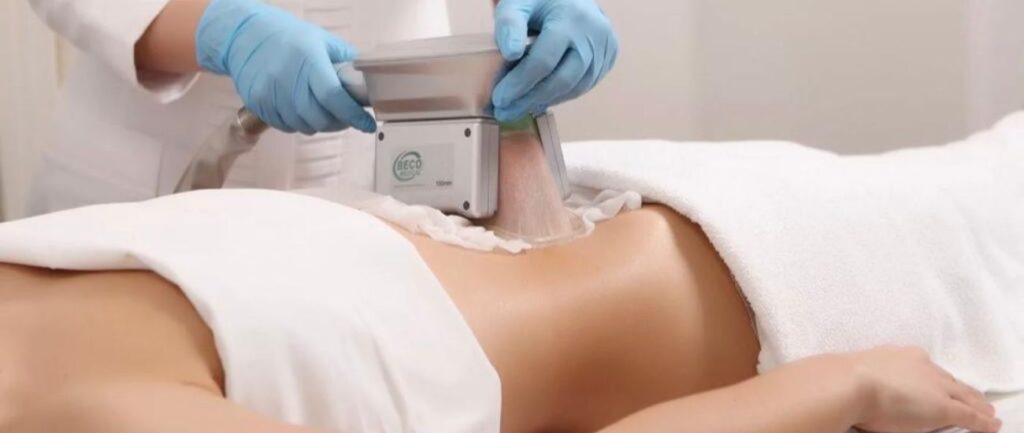 Cool Sculpt Treatment